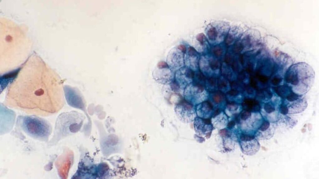 Frotiu Babeș-Papanicolau la microscop, cu un grup de celule cervicale atipice