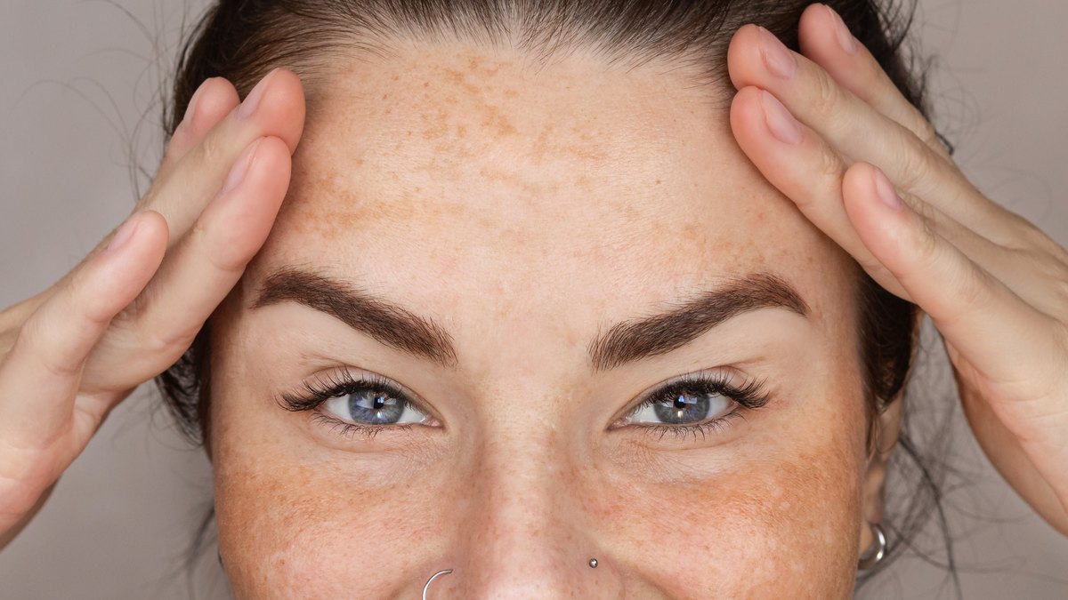 Cum scapi de petele pigmentare - laser, peeling, Dermapen sau cremă depigmentantă