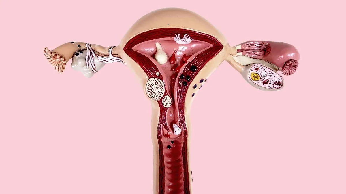Model anatomic în secțiune al uterului, colului uterin și ovarelor, cu diverse leziuni, pe fundal roz
